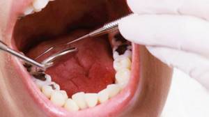 перфорация канала зуба при лечении пульпита