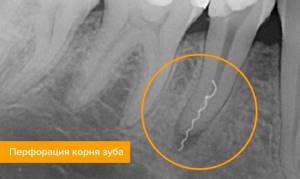 Перфорация корня зуба на рентгене