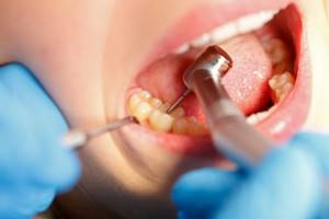 перфорация корня зуба симптомы