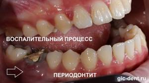 Периодонтит зуба 3.6