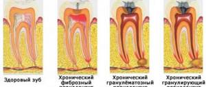 Periodontitis