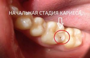 Первая стадия – начальная стадия кариеса - когда на зубе появляется меловидное пятно