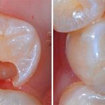 Пломбирование у детей- какие пломбы ставят на молочные зубы