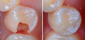 Пломбирование у детей- какие пломбы ставят на молочные зубы