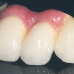 Плюсы и минусы искусственной десны