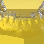 Плюсы и минусы сплинт терапии в стоматологии