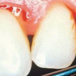 Why do gums bleed under a crown where there is no tooth?