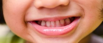 Why do babies get caries?