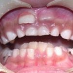 Почему вырастают акульи зубы у человека