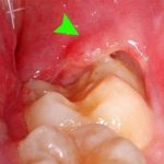 Indications for extraction of jaw units overgrown with gums