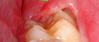 Indications for extraction of jaw units overgrown with gums