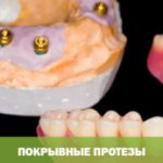 покрывные протезы