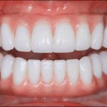 Полностью съемный протез