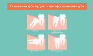 Положения зуба мудрости при прорезывании зуба в картинках