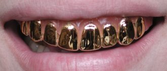 Преимущества и виды золотых коронок. Как отделить от зубов и почистить изделие?