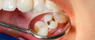 The cause of toothache is caries