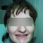 Reasons for the absence of incisors and ways to correct the defect