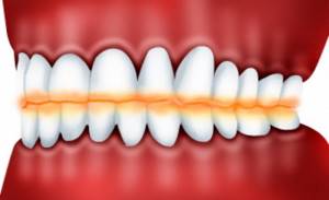 Причины повышенной стираемости зубов