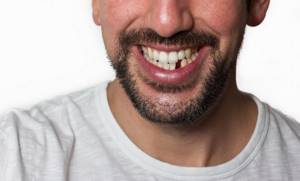 причины шатающихся зубов у взрослого