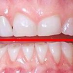 Пришлифовывание зубов – что это, как проводится