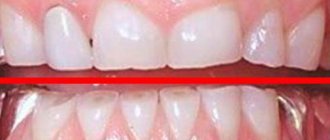 Пришлифовывание зубов – что это, как проводится