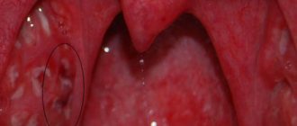 signs of sore throat complications