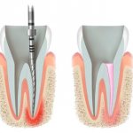 Процесс двухэтапной имплантации