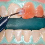 Процесс отбеливания Opalescense в клинике