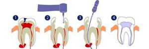 процесс терапевтического лечения узла в районе корня зуба