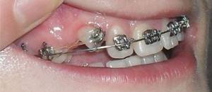 Профилактика дистопии зубов