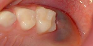прорезывание жевательных зубов у детей