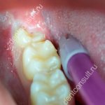 прорезывание зуба мудрости фото