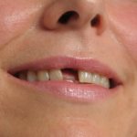 протезирование одного зуба без обточки соседних зубов