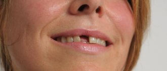 протезирование одного зуба без обточки соседних зубов
