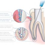 Protocol for root canal irrigation in the treatment of pulpitis