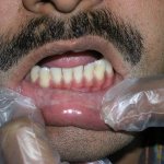 Lip cancer caused by smoking