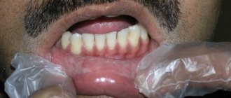 Lip cancer caused by smoking