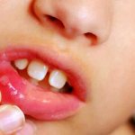 Ранки во рту стоматит