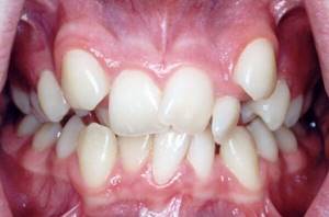 Разновидности дистопии зубов