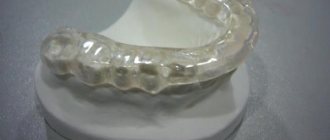 disconnecting mouthguard in dentistry