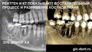 Разрушение костной ткани зуба