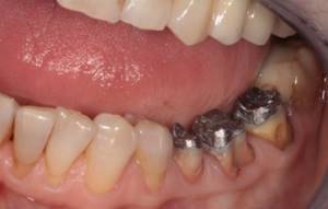 Разрушение зубов в следствии неправильного прикуса - бесконечные пломбы, потом коронки, потом - импланты