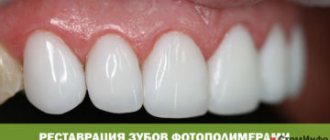 Dental restoration with photopolymers