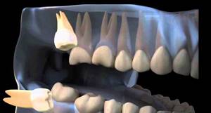 ретинированный дистопированный зуб