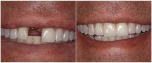 Результат имплантации зубов