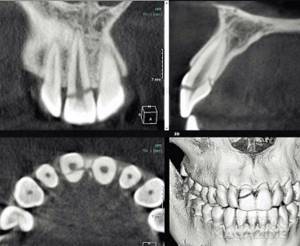 Рис. 1. КТ, визуализация зуба 11, MPR; перелом в пределах эмали, дентина и пульпы.