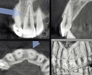 Рис. 3. КТ, визуализация зуба 21, MPR; перелом корня в пределах цемента, дентина и пульпы.