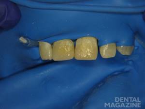 Рис. 4. Зубы 1.1 и 2.1: внесение эмалевого оттенка TD.