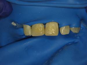 Рис. 4. Зубы 1.1 и 2.1: внесение эмалевого оттенка TD.
