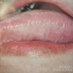 Рис. 6. Волосистая лейкоплакия на боковой поверхности языка.